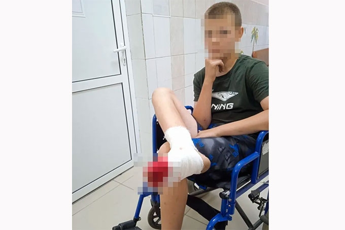 Подросток из села Кетово во время игры в футбол получил серьезную травму